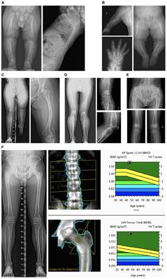 Genetic Analysis Using a Next Generation Sequencing-Based Gene Panel in Patients With Skeletal Dysplasia: A Single-Center Experience